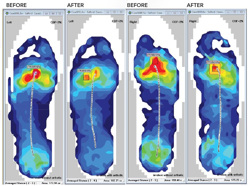 Screenshot displays pressure distribution in a trainer type shoe only "before" with the orthotic device "after."